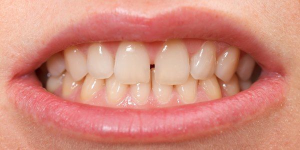 diastema