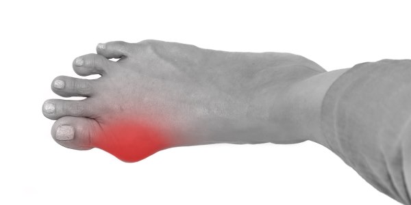 alluce valgo operazioni inutili fini estetici