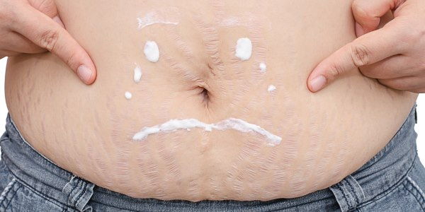 rimedi naturali smagliature