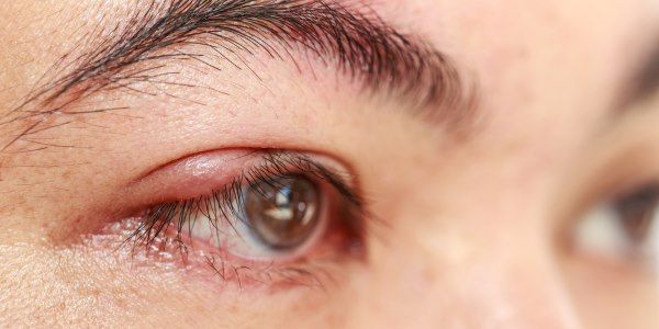 orzaiolo rimedi naturali