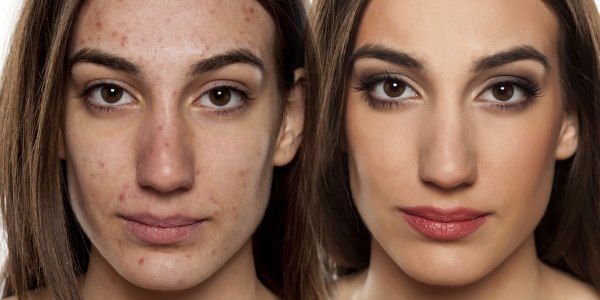 brufoli acne batteri